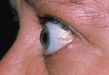 Bulging Eyes: Symptoms, Causes, Treatment