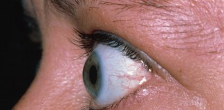 Bulging Eyes: Symptoms, Causes, Treatment