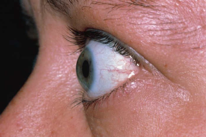 Bulging Eyes: Symptoms, Causes, Treatment