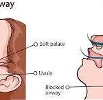 Sleep Apnea